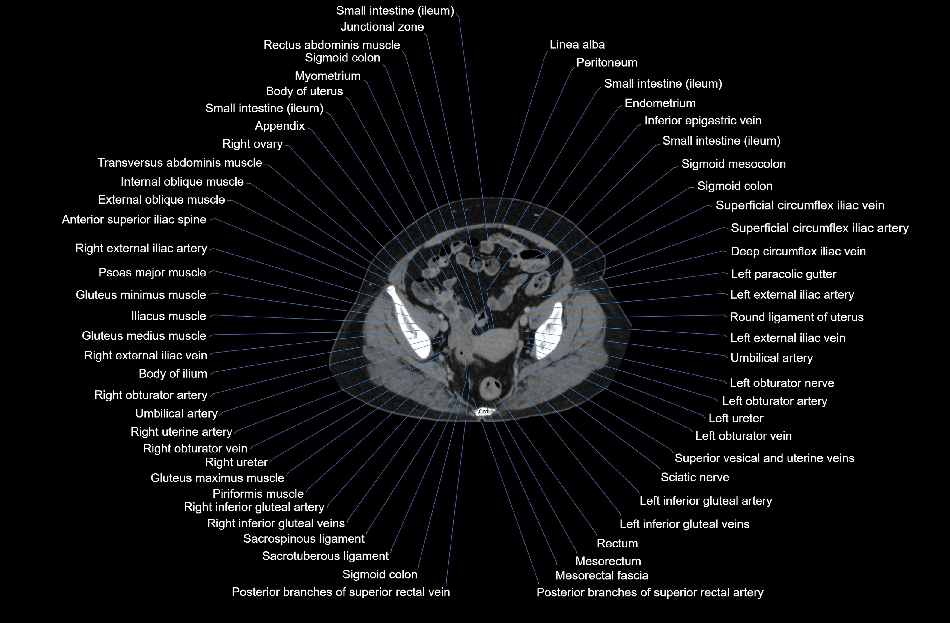 CT Abdomen axial cross sectional anatomy labelled radiology image-00082.webp